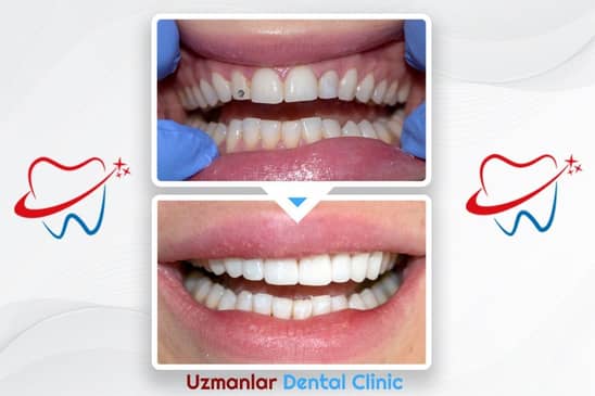 Slider image (9) Uzmanlar Dental Clinic